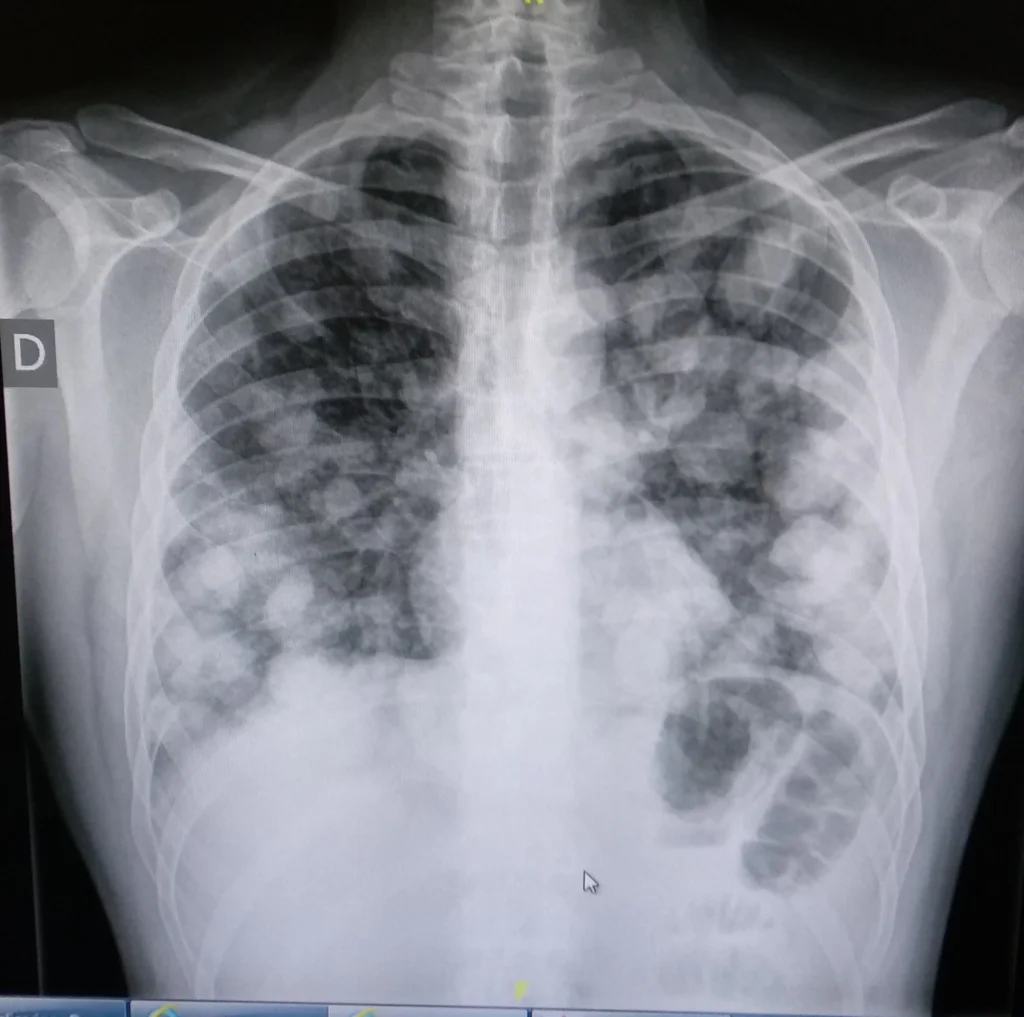Metástasis pulmonar