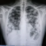 Metástasis pulmonar