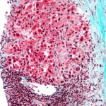 Carcinoma hepatocelular