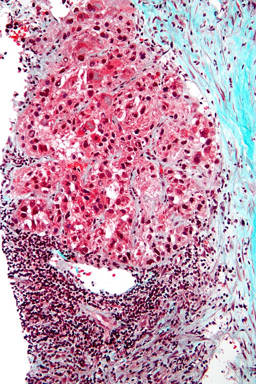 Carcinoma hepatocelular