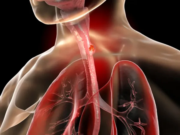Cáncer de esófago