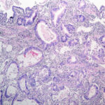 Adenocarcinoma gástrico