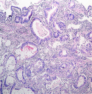 Adenocarcinoma gástrico