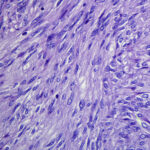 Tumores mesenquimales gastrointestinales