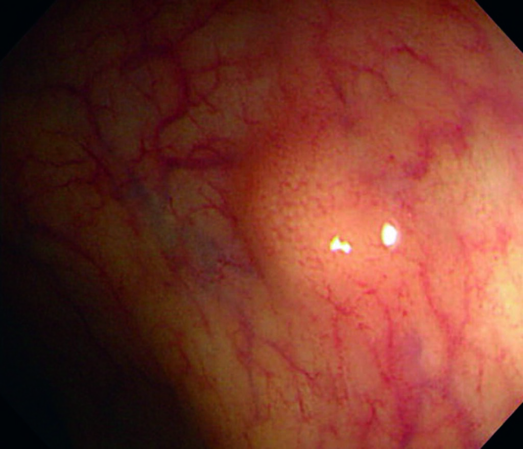 Tumores neuroendocrinos intestinales