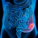 Manifestaciones clínicas del cáncer colorrectal