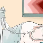 Detección de neoplasias colorrectales