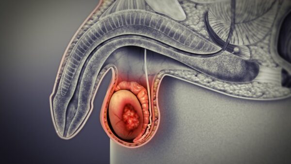 Cáncer testicular (Tumores de Células Germinales)