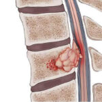 Compresión de la médula espinal por metástasis