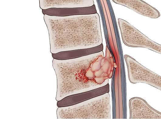 Compresión de la médula espinal por metástasis