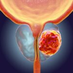 Diagnóstico de cáncer de próstata