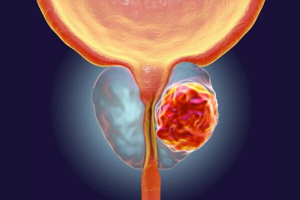 Diagnóstico de cáncer de próstata