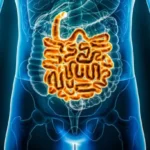 Lesiones malignas del intestino delgado