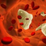 Hipercalcemia en pacientes con cáncer