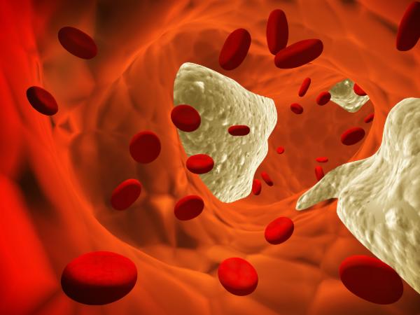 Hipercalcemia en pacientes con cáncer