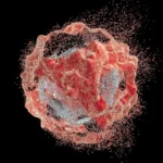 Hiperuricemia y síndrome de lisis tumoral