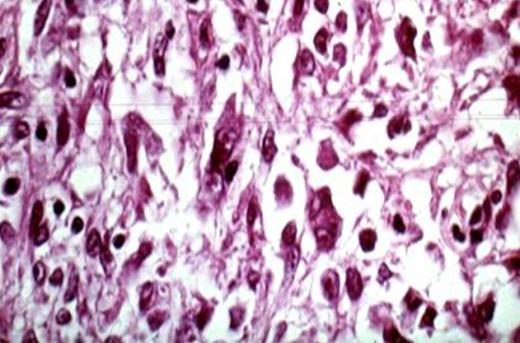 Enfermedad de Gaucher