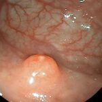 Tumores neuroendocrinos gástricos