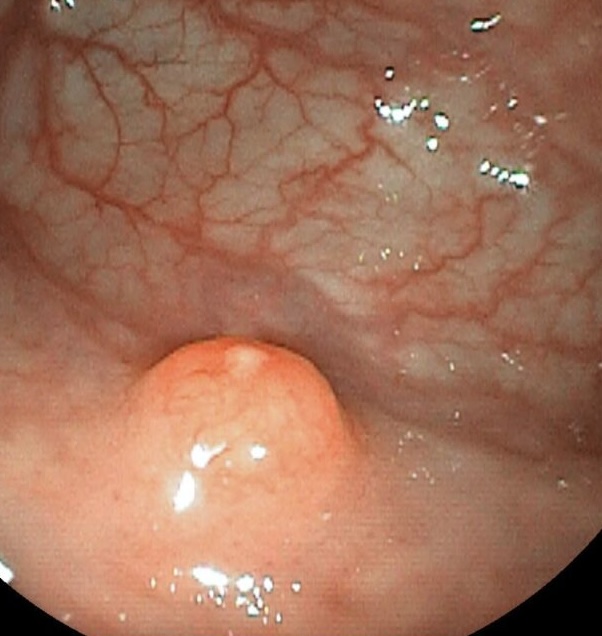 Tumores neuroendocrinos gástricos