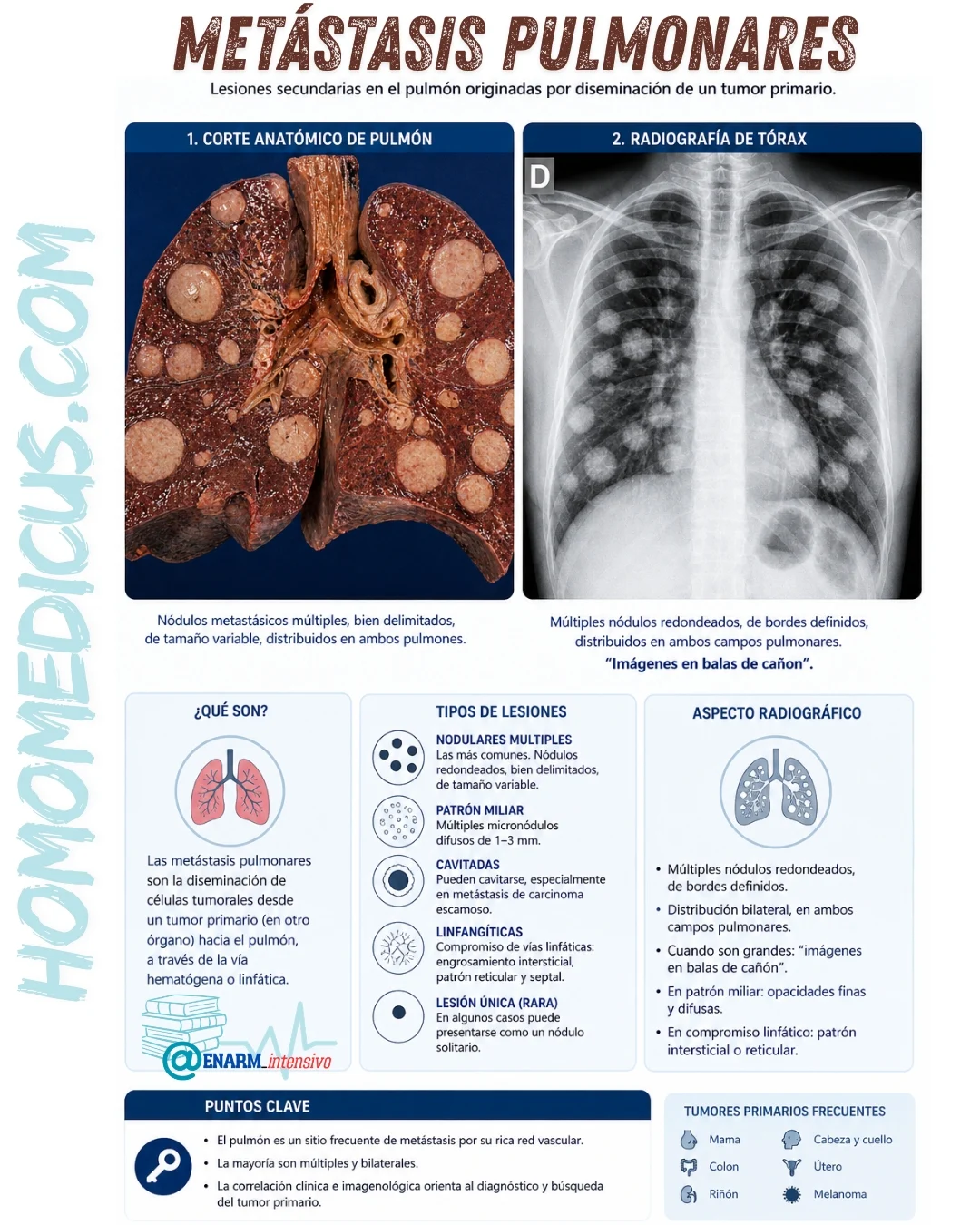 METÁSTASIS PULMONARES METÁSTASIS PULMONARES