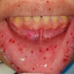 Telangiectasia hemorrágica hereditaria