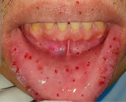 Telangiectasia hemorrágica hereditaria