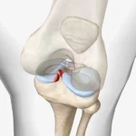 Lesiones del menisco