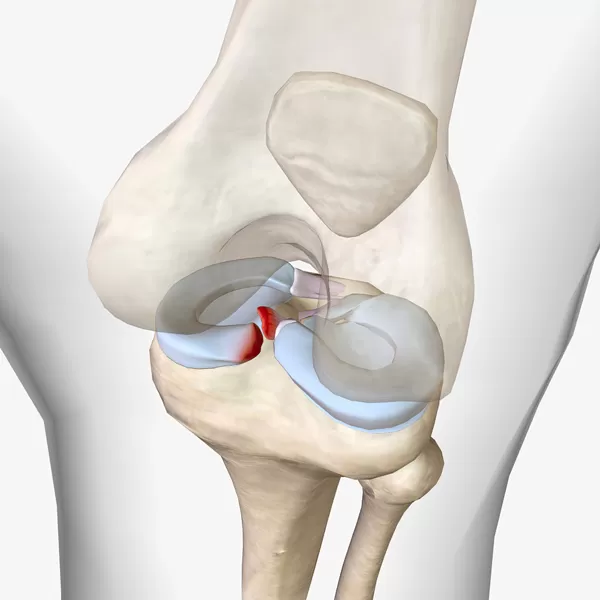 Lesiones del menisco
