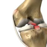 Lesión del ligamento cruzado posterior