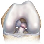 Lesión del ligamento cruzado anterior