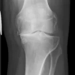 Artrosis de rodilla