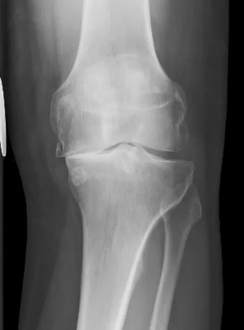 Artrosis de rodilla