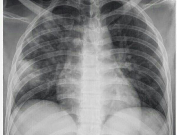 Valoración radiológica de las enfermedades pulmonares