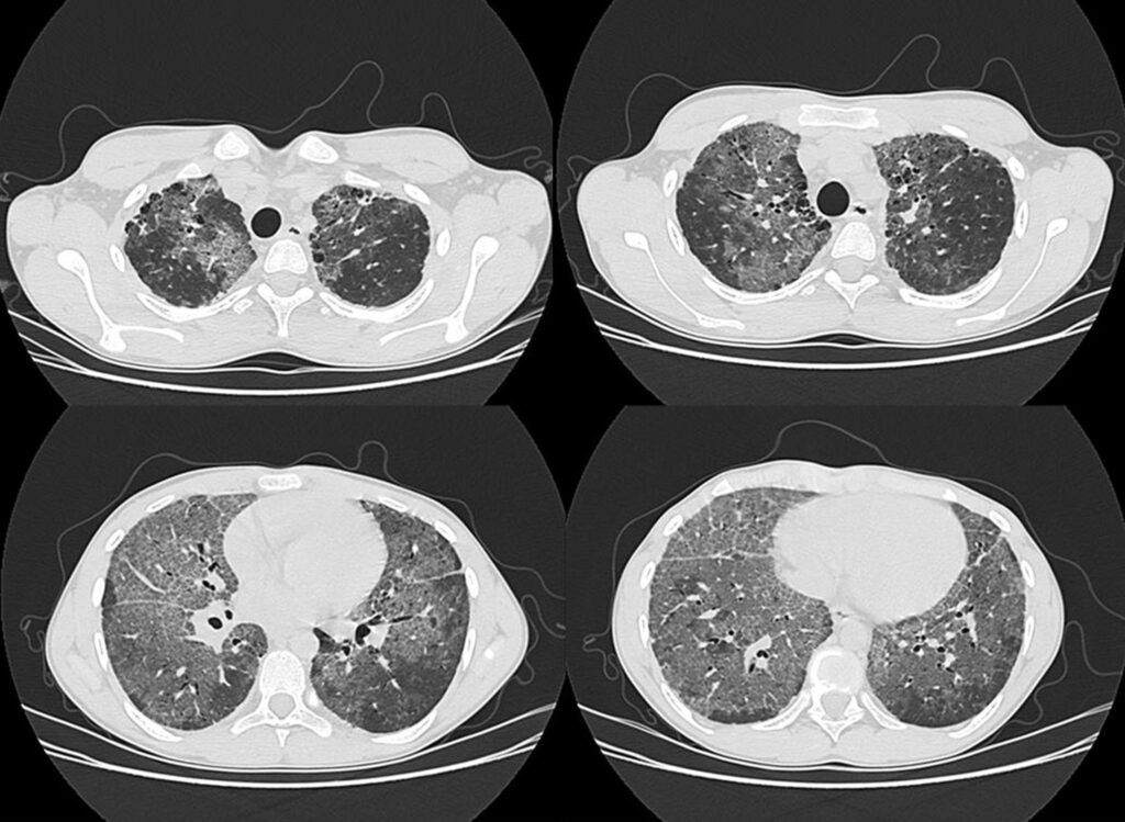 Tomografia computarizada en el estudio de enfermedades pulmonares