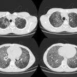 Tomografia computarizada en el estudio de enfermedades pulmonares