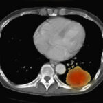 Técnicas de imagen alternativas para el estudio de las enfermedades pulmonares