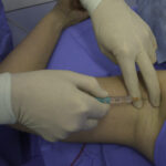 Lesión nerviosa por anestesia regional