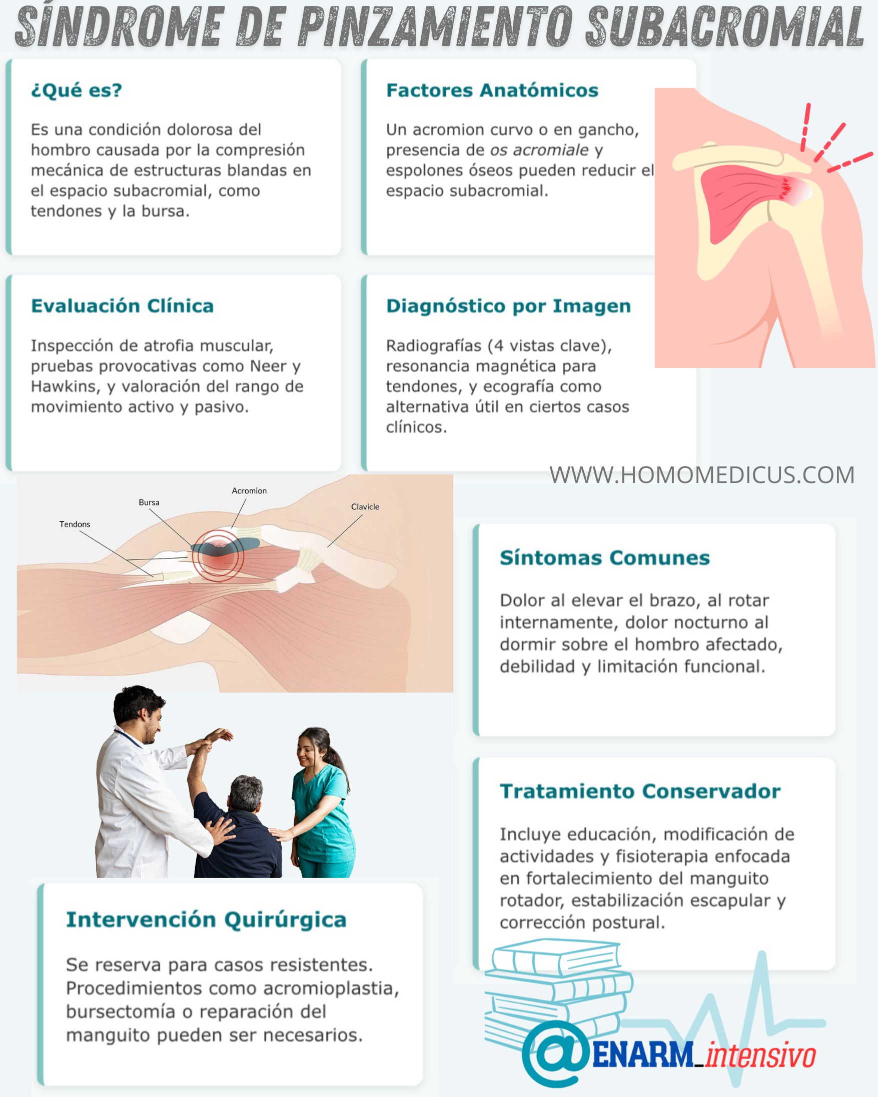 🎴TARJETA DE REPASO: Síndrome de pinzamiento subacromial