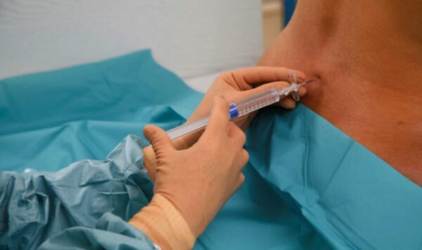 Hematoma como complicación de la anestesia regional