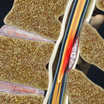 Complicaciones infecciosas de la anestesia regional