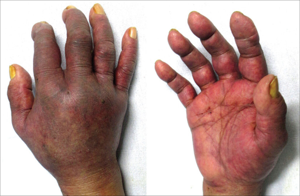 Síndrome del guante púrpura