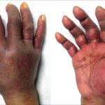 Síndrome del guante púrpura