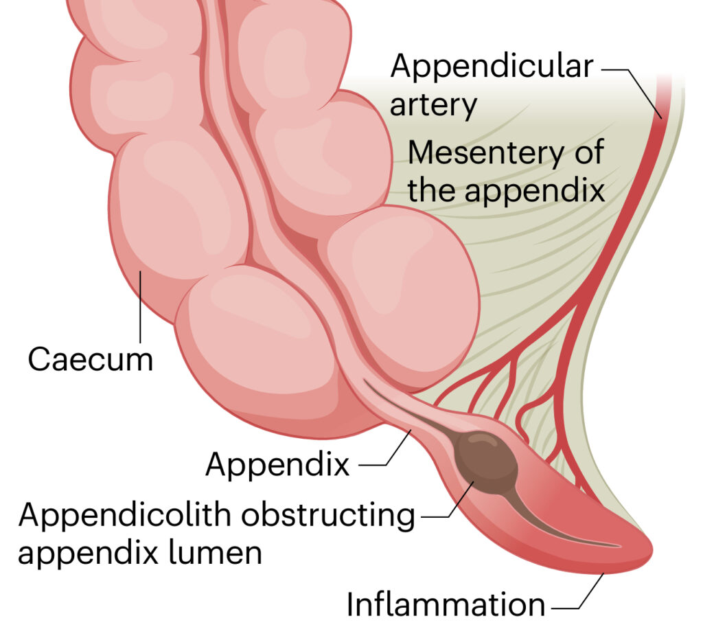 Inflamación del apéndice cecal