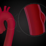 Hematoma intramural y disección aórticos