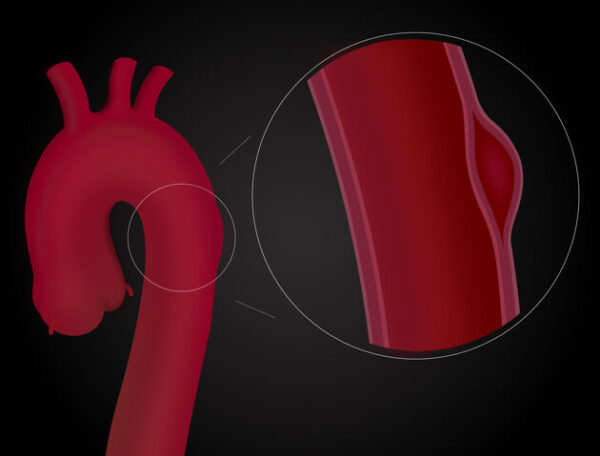 Hematoma intramural y disección aórticos