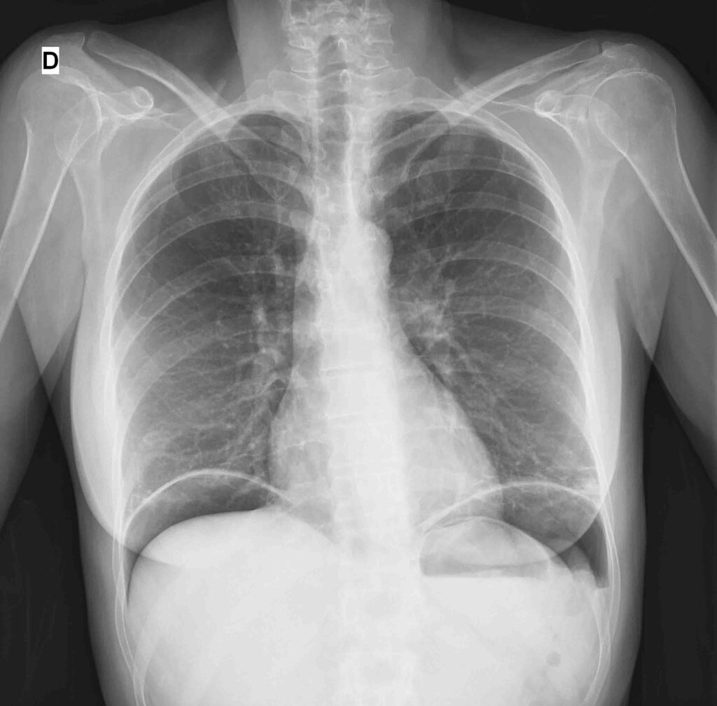 Diagnóstico de perforación gastroduodenal