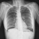 Diagnóstico de perforación gastroduodenal