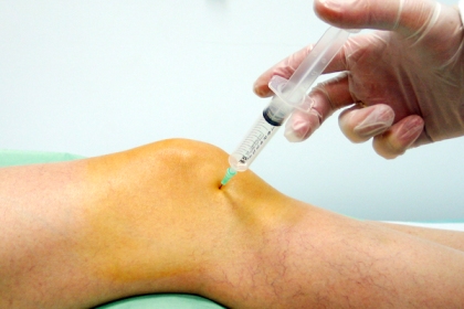 Artrocentésis evacuadora de rodilla