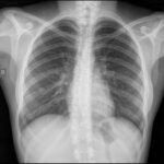 Las 5 densidades básicas de la radiografía convencional