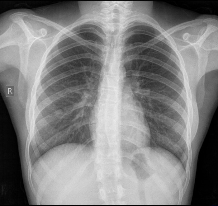 Las 5 densidades básicas de la radiografía convencional